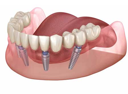 All-On-4® Implant Dentures Treatment