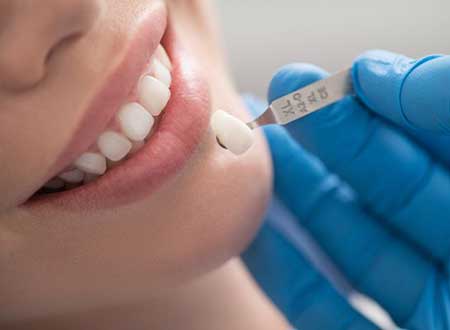 Cosmetic Veneers Treatment