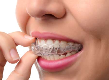 Invisalign Treatment