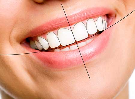 Smile Design Treatment