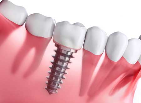 Dental Implant Treatment