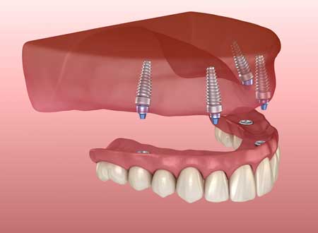 Implant Supported Dentures Treatment