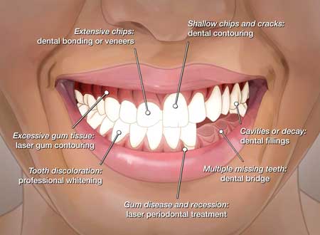 Full Mouth Reconstruction Treatment