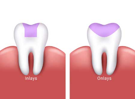 Inlay-Onlay Restorations