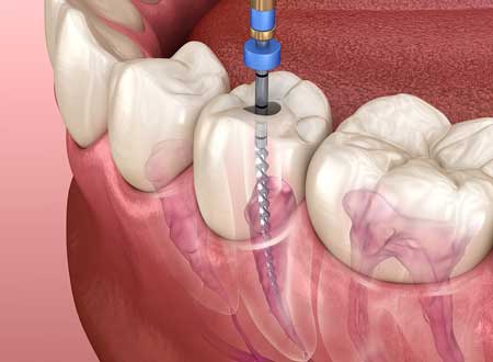 Root Canal Dentistry Treatment