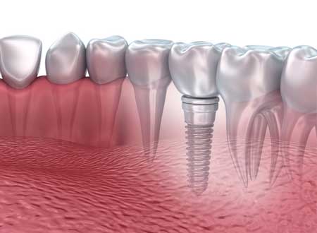 Dental Implant Treatment