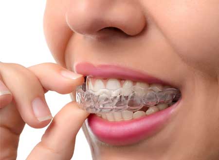 Invisalign Treatment