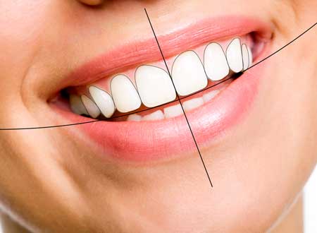 Smile Design Treatment