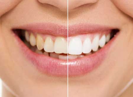 Teeth Whitening Treatment