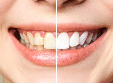 Teeth Whitening Treatment